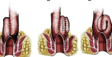 Para qué sirve la colostomía Para qué sirve la colostomía
